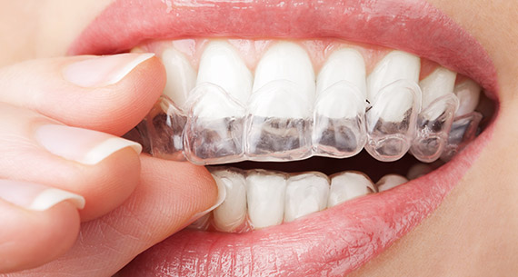 teeth whitening special form